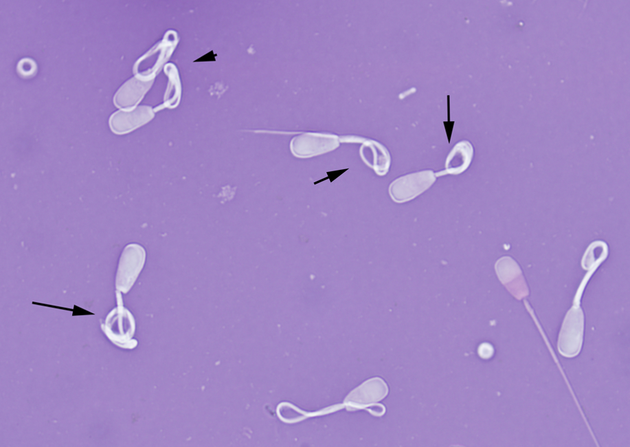 severely coiled midpiece sperm