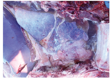 Distension of the pericardial sac