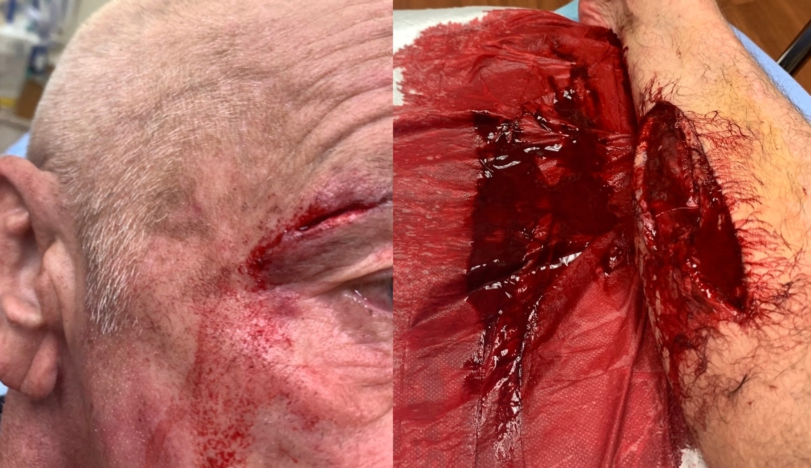 Head and leg wounds