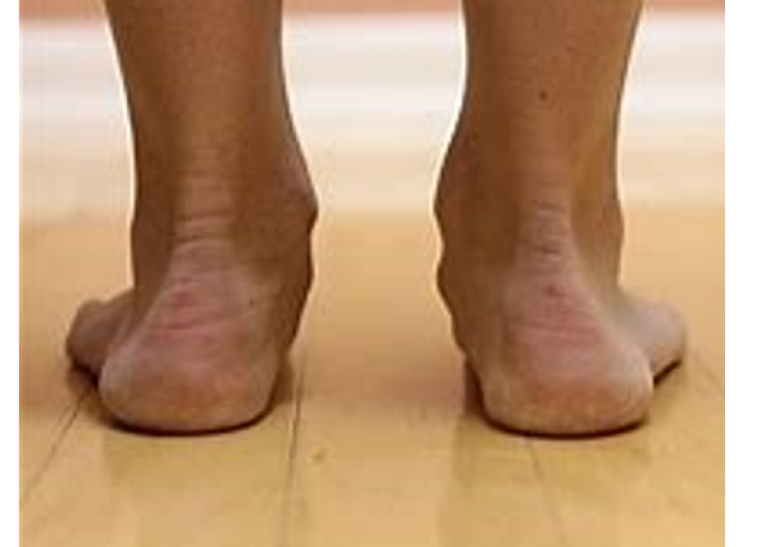 Flat feet