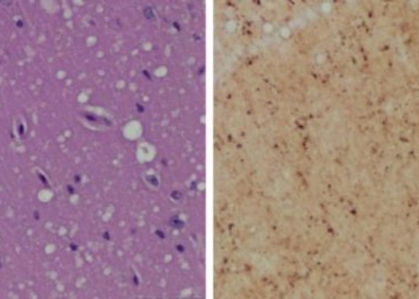 Staining (Left) shows spongiform degeneration. Staining (Right) shows intense misfolded prion protein.