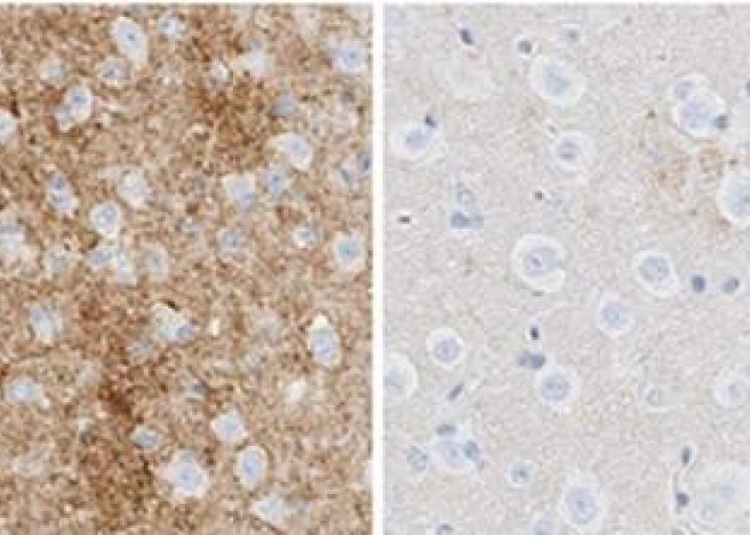 In these images of mouse brain infected with scrapie, the image on the left was treated with an inactive ASO and shows prion accumulation (brown). The image on the right was treated with an active ASO and shows little accumulation at a comparable timepoint.